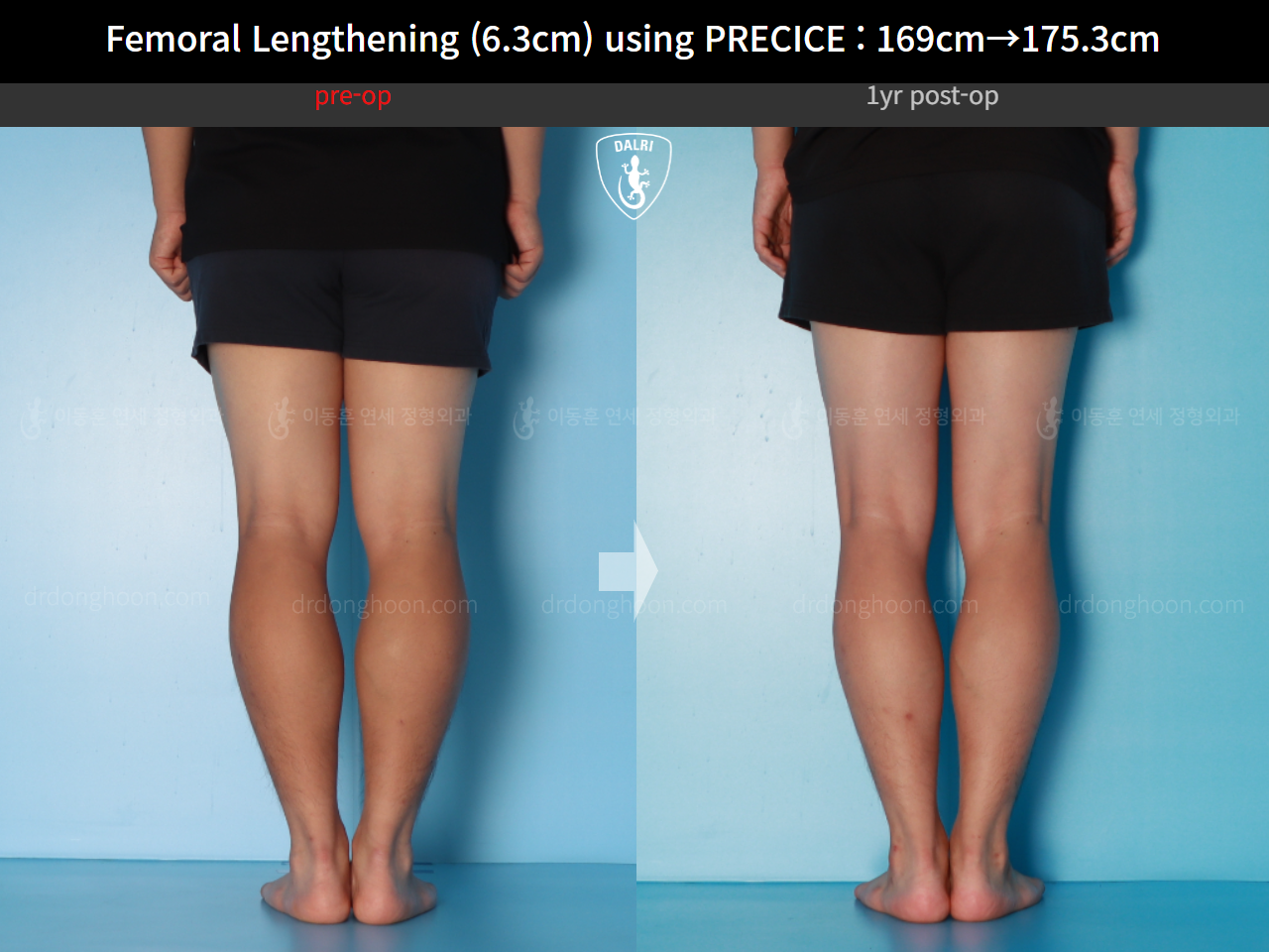Before and after cll precice, case 16070058, image 10, Dr. Donghoon institute (DALRI)