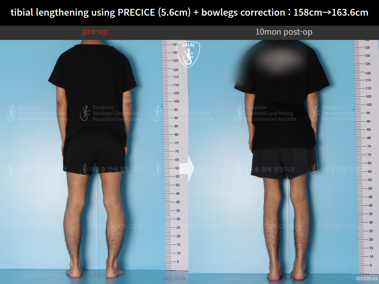 Before and after cll + deformity correction, case 15043777, image 3, Dr. Donghoon institute (DALRI)
