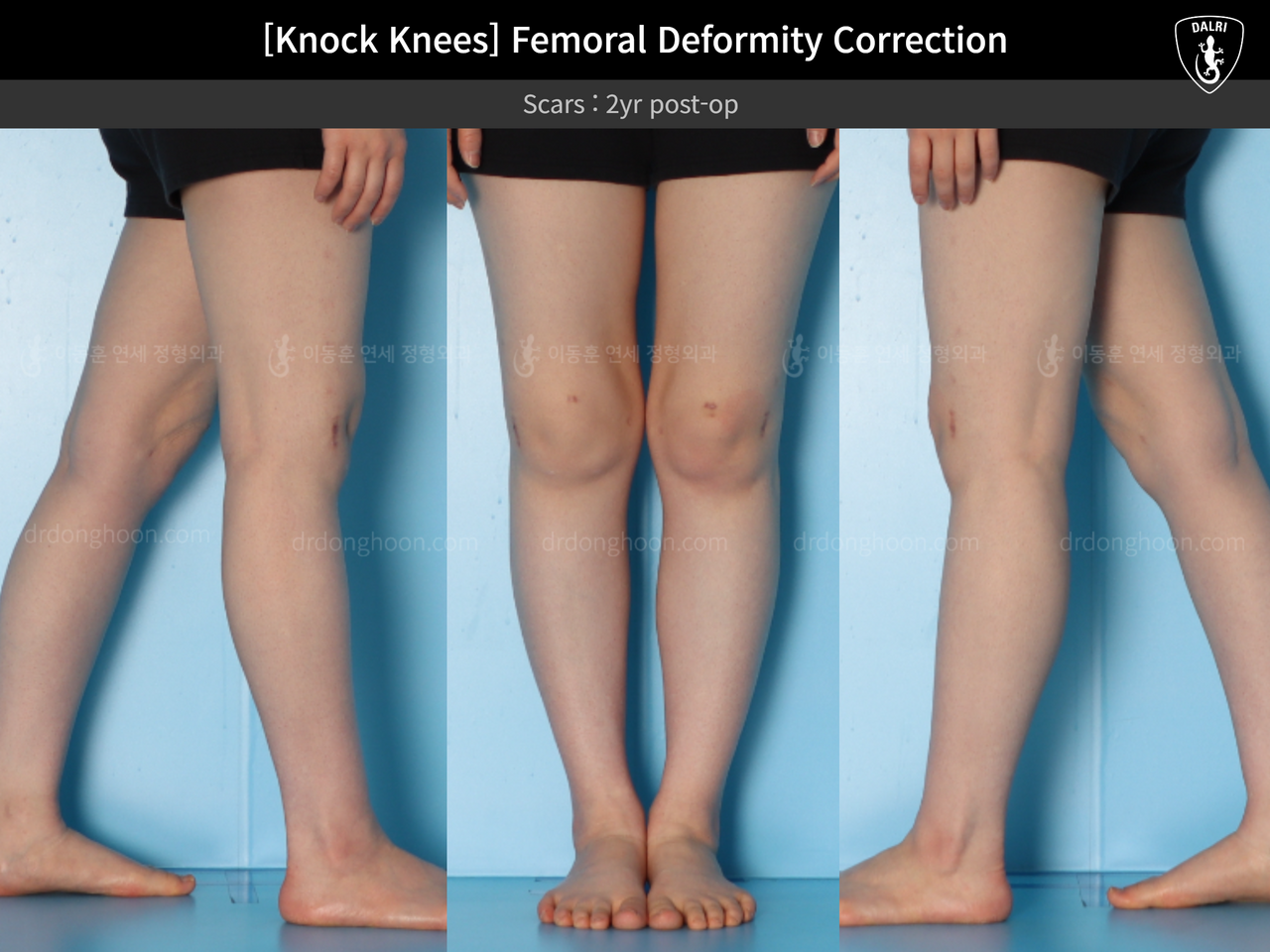 Before and after adult knock knees, case 14343877, image 5, Dr. Donghoon institute (DALRI)