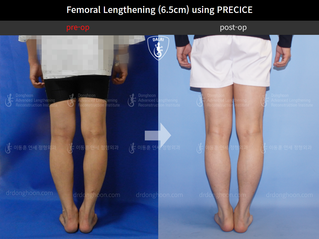 Before and after cll precice, case 4323401, image 6, Dr. Donghoon institute (DALRI)