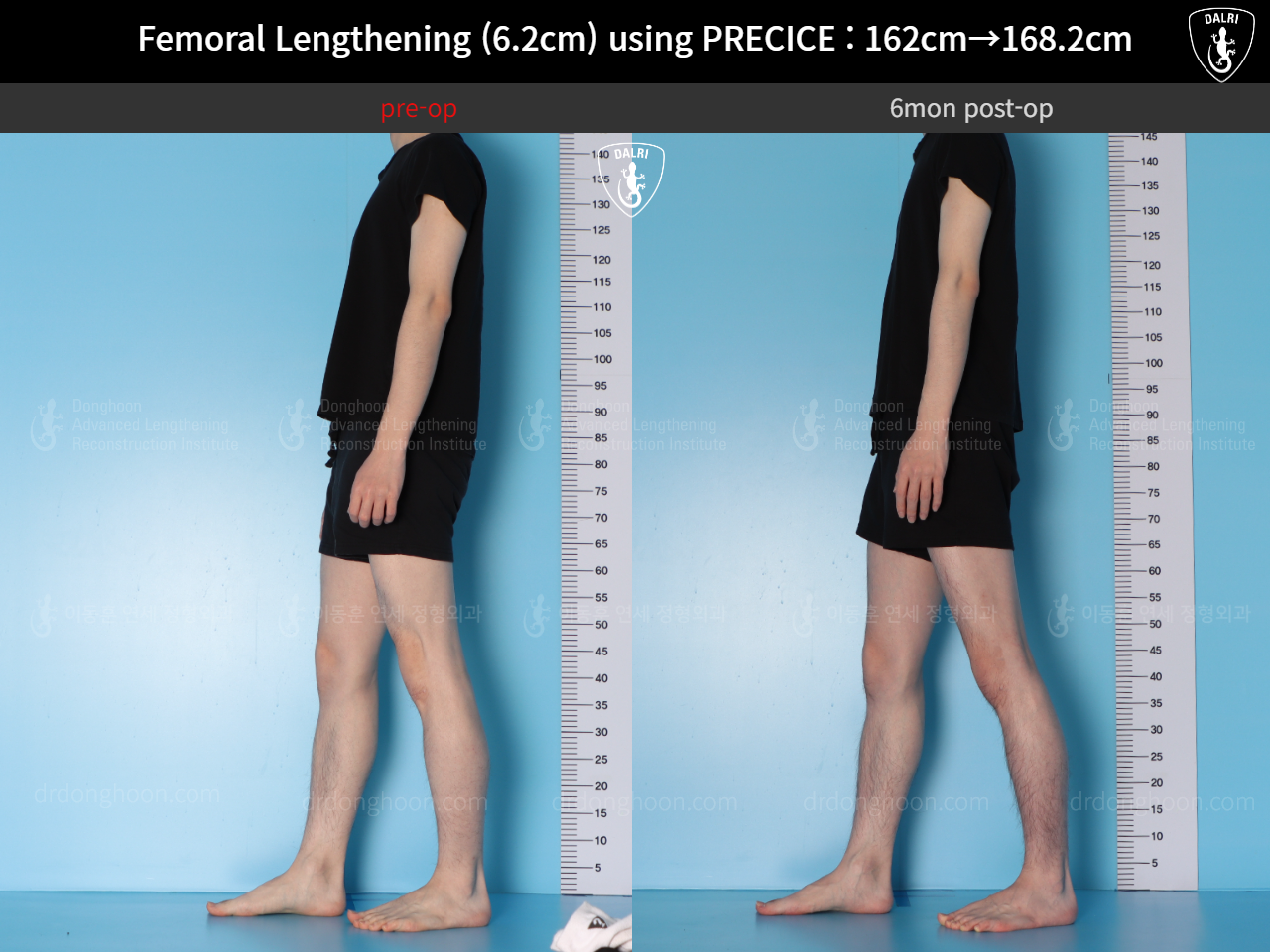 Before and after cll precice, case 15393865, image 8, Dr. Donghoon institute (DALRI)