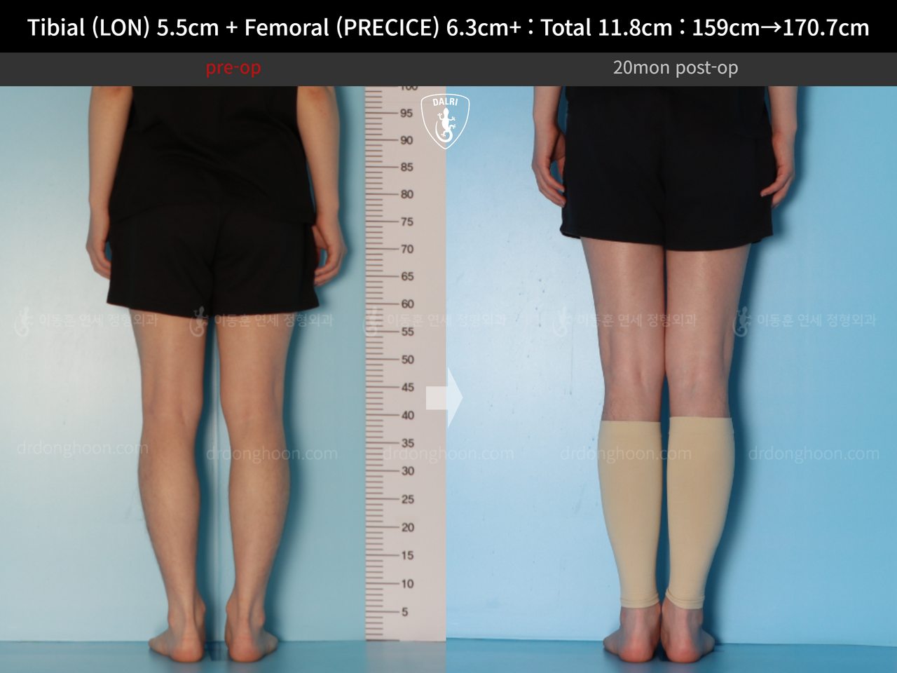 Before and after cll lon, case 14390077, image 8, Dr. Donghoon institute (DALRI)