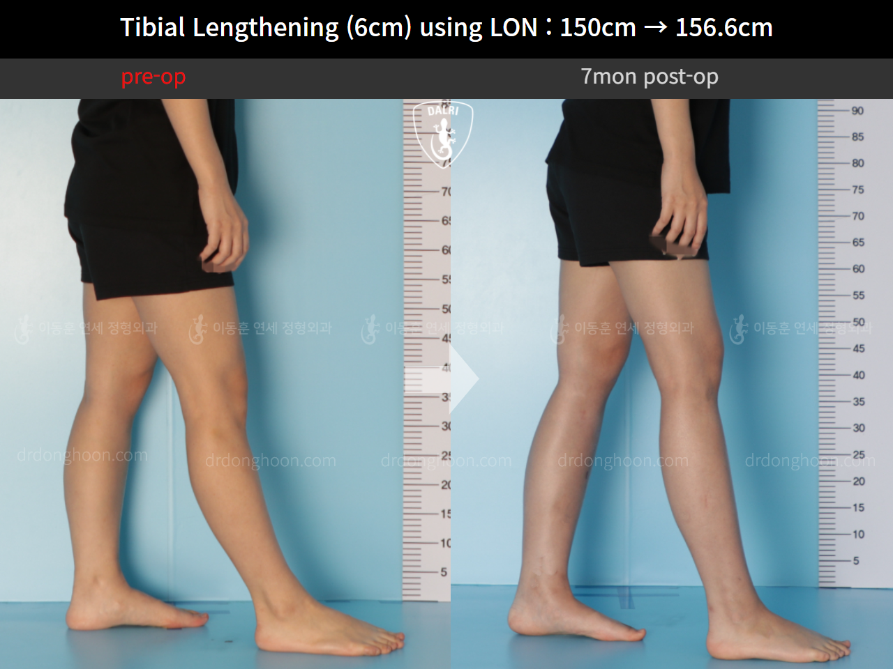Before and after cll lon, case 9992030, image 8, Dr. Donghoon institute (DALRI)