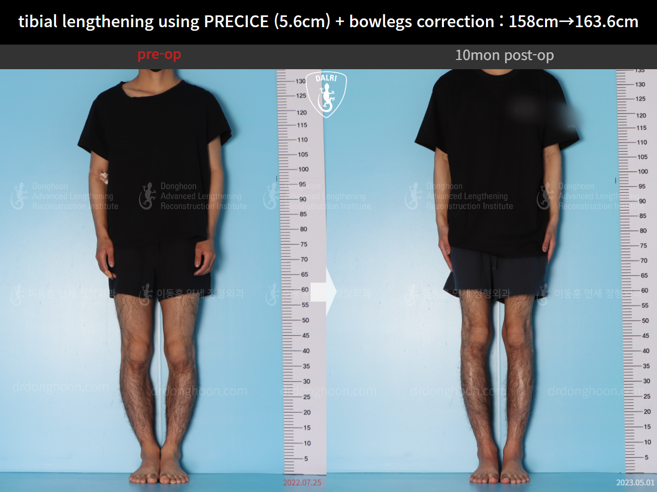 Before and after cll precice, case 15043786, image 1, Dr. Donghoon institute (DALRI)