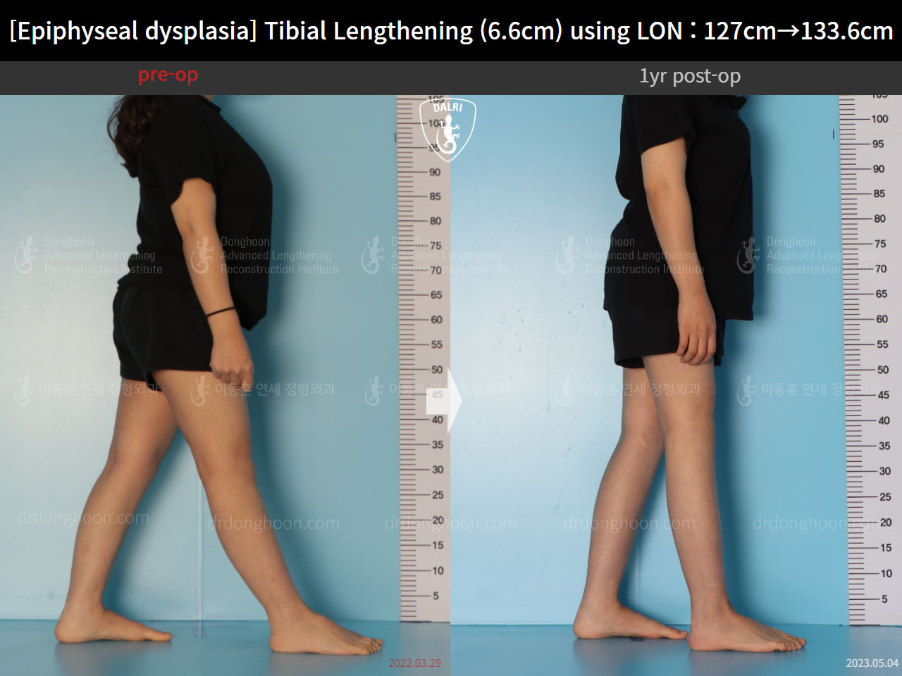 Before and after congenital condition, case 15072062, image 5, Dr. Donghoon institute (DALRI)