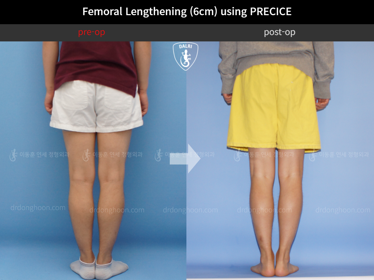 Before and after cll precice, case 4573616, image 4, Dr. Donghoon institute (DALRI)