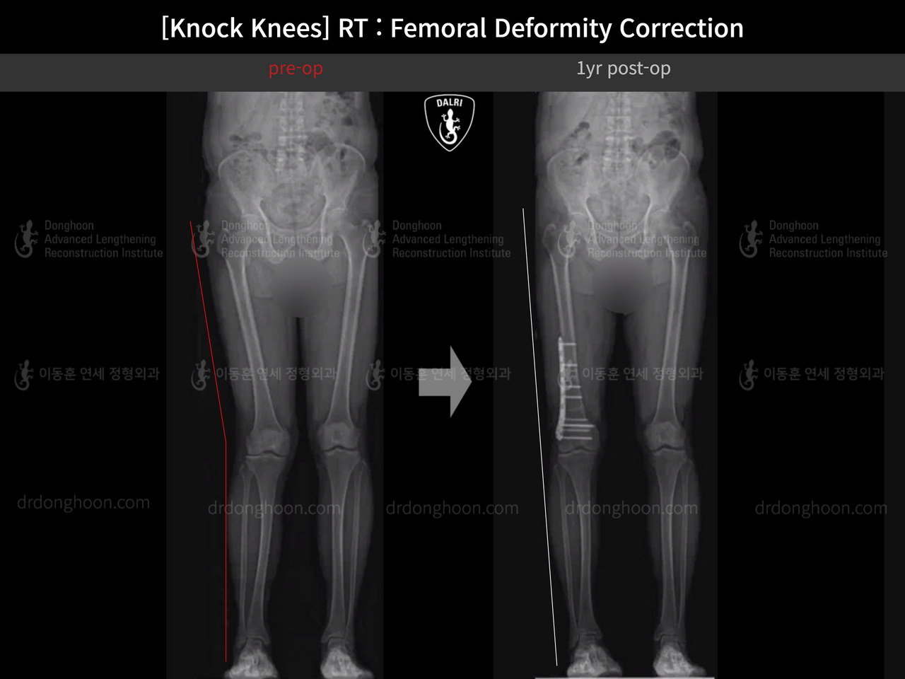 Before and after adult knock knees, case 14236357, image 12, Dr. Donghoon institute (DALRI)