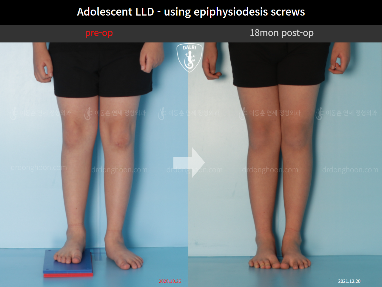 Before and after paediatric & adolescent lld, case 10439770, image 3, Dr. Donghoon institute (DALRI)