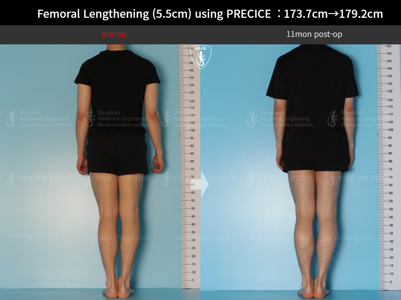 Before and after cll precice, case 18140453, image 2, Dr. Donghoon institute (DALRI)