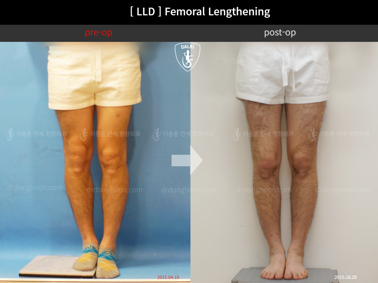Before and after adult lld, case 11651275, image 3, Dr. Donghoon institute (DALRI)