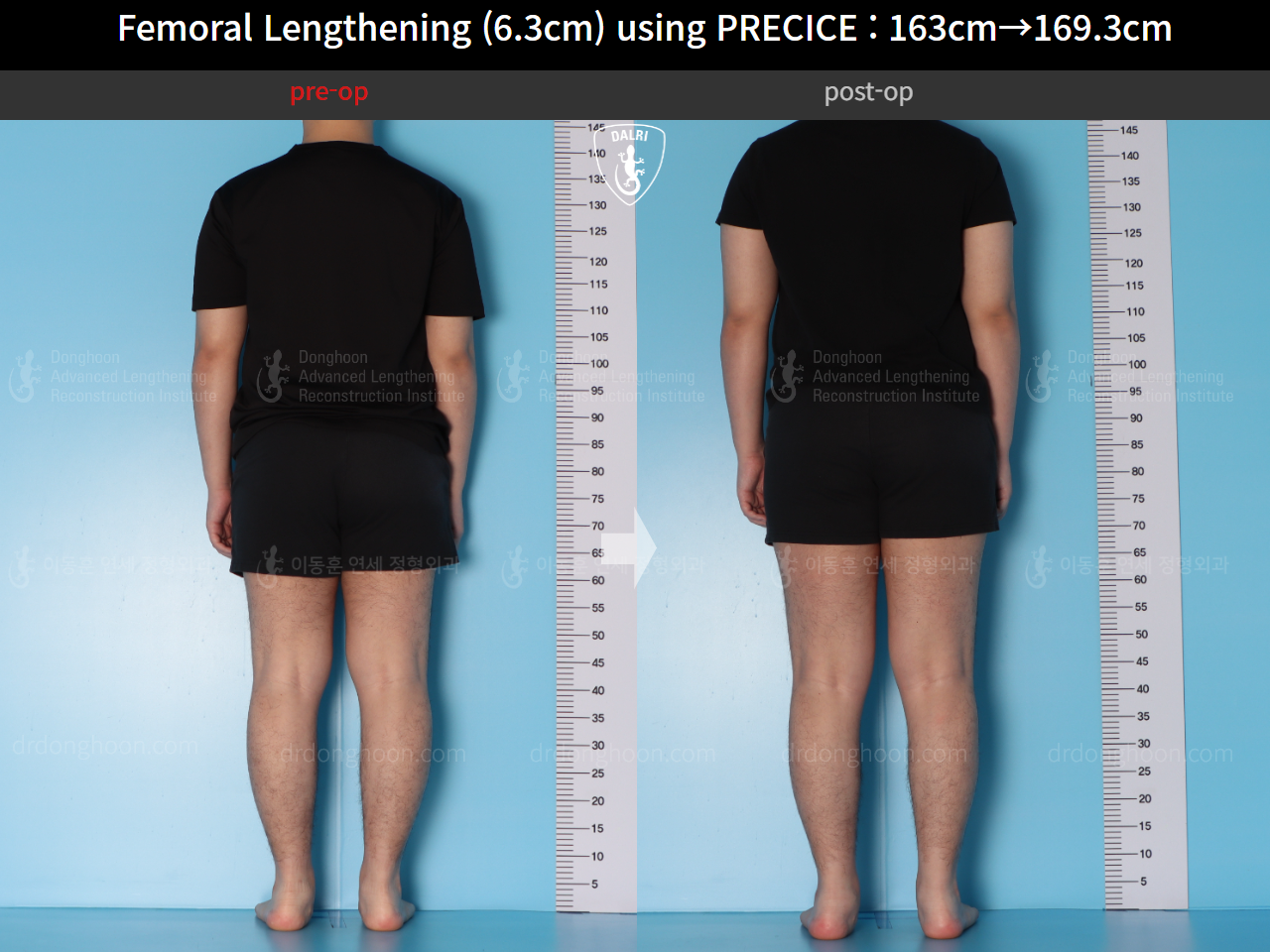 Before and after cll precice, case 15639837, image 4, Dr. Donghoon institute (DALRI)