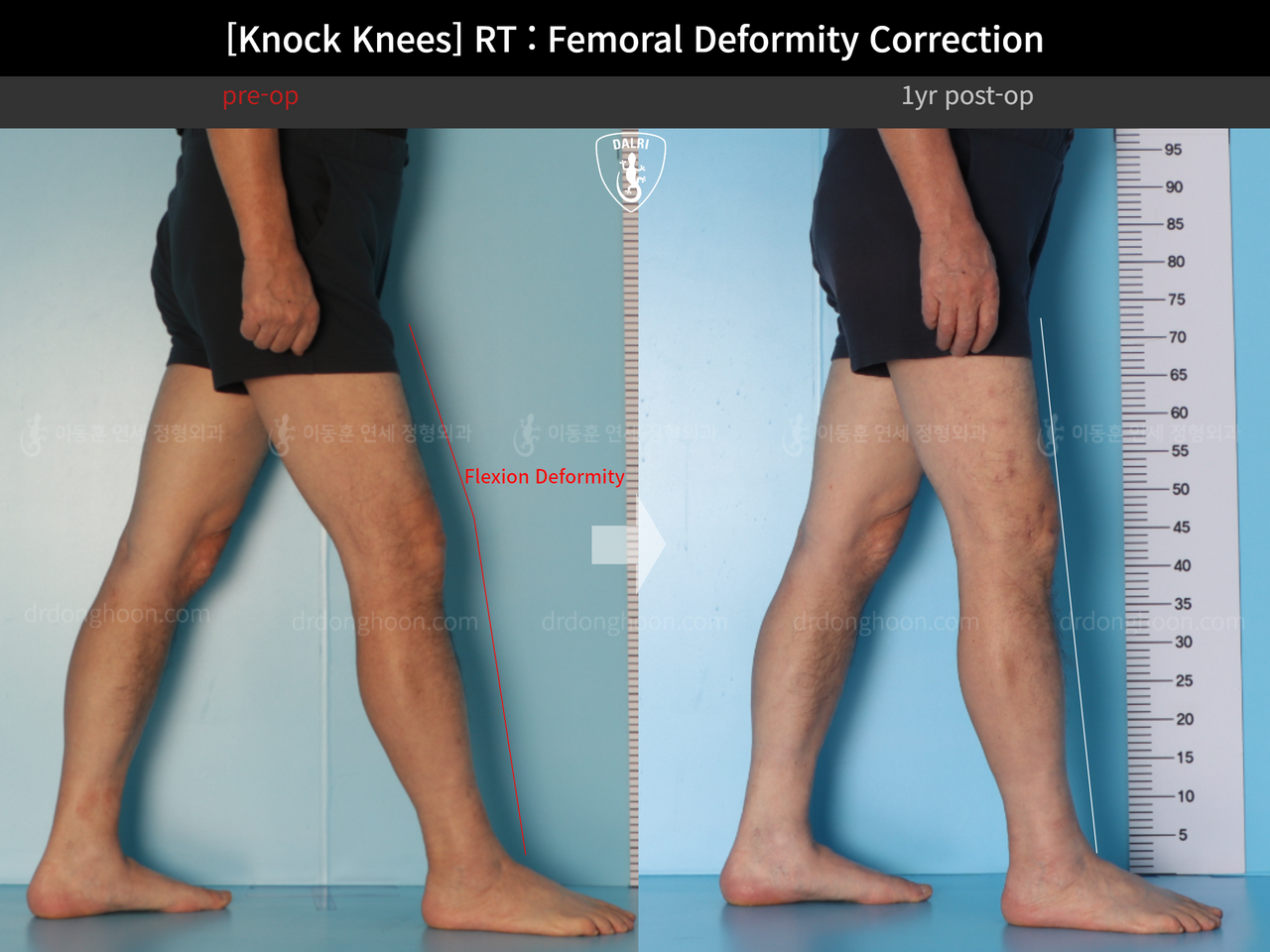 Before and after adult knock knees, case 14236357, image 7, Dr. Donghoon institute (DALRI)
