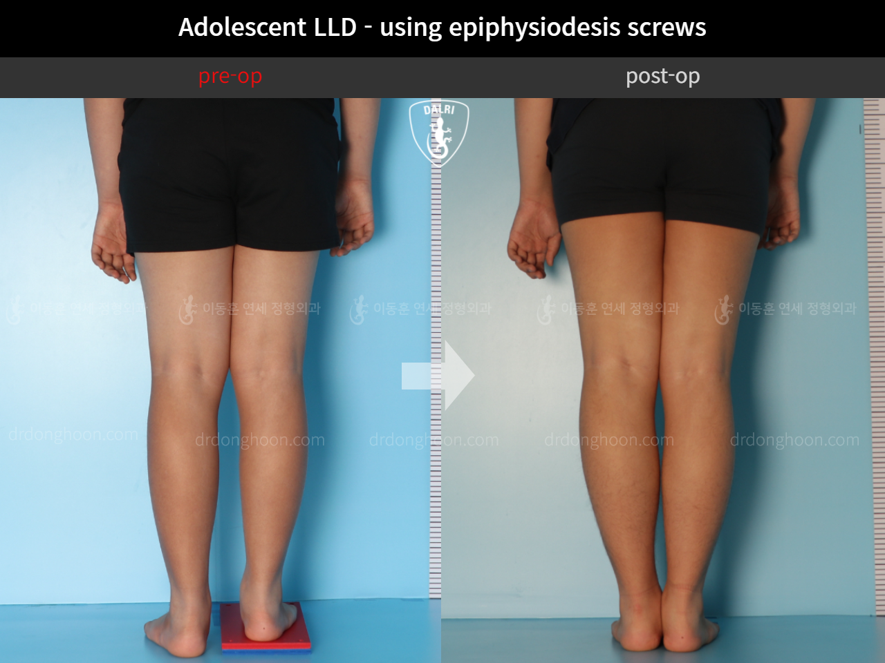 Before and after paediatric & adolescent lld, case 11472870, image 6, Dr. Donghoon institute (DALRI)
