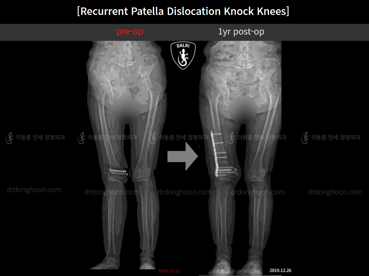 Before and after adult knock knees, case 11291745, image 2, Dr. Donghoon institute (DALRI)