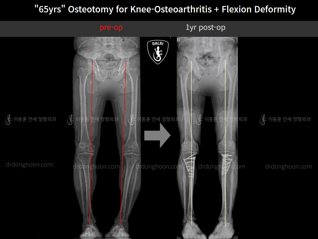 Before and after osteotomy for knee osteoarthritis, case 10742820, image 8, Dr. Donghoon institute (DALRI)