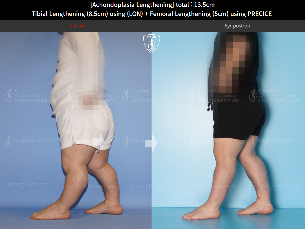 Before and after cll lon, case 14993527, image 7, Dr. Donghoon institute (DALRI)