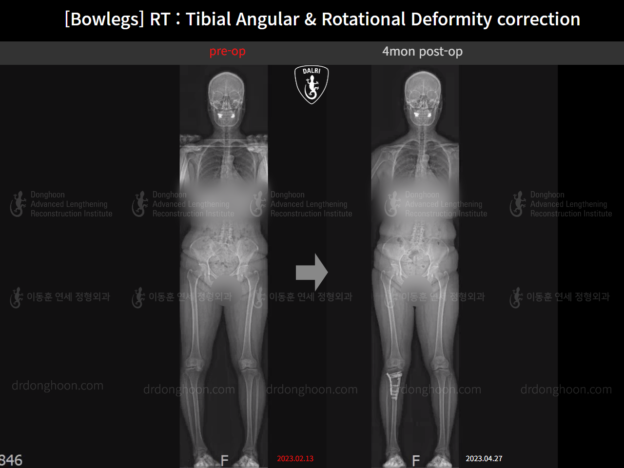 Before and after adult bowlegs, case 15741874, image 11, Dr. Donghoon institute (DALRI)