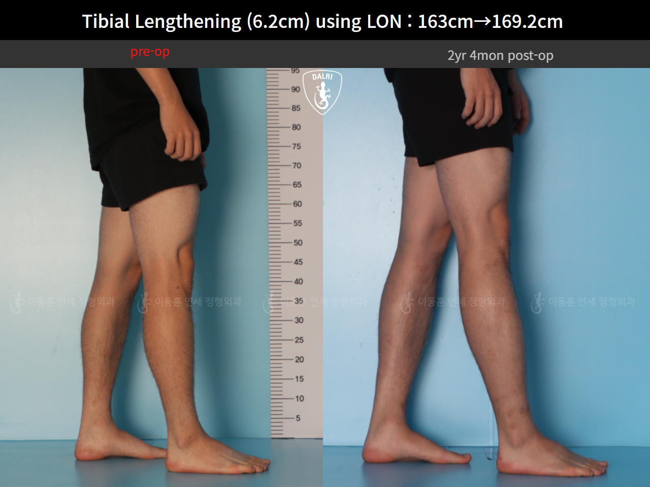 Before and after cll lon, case 128449546, image 9, Dr. Donghoon institute (DALRI)