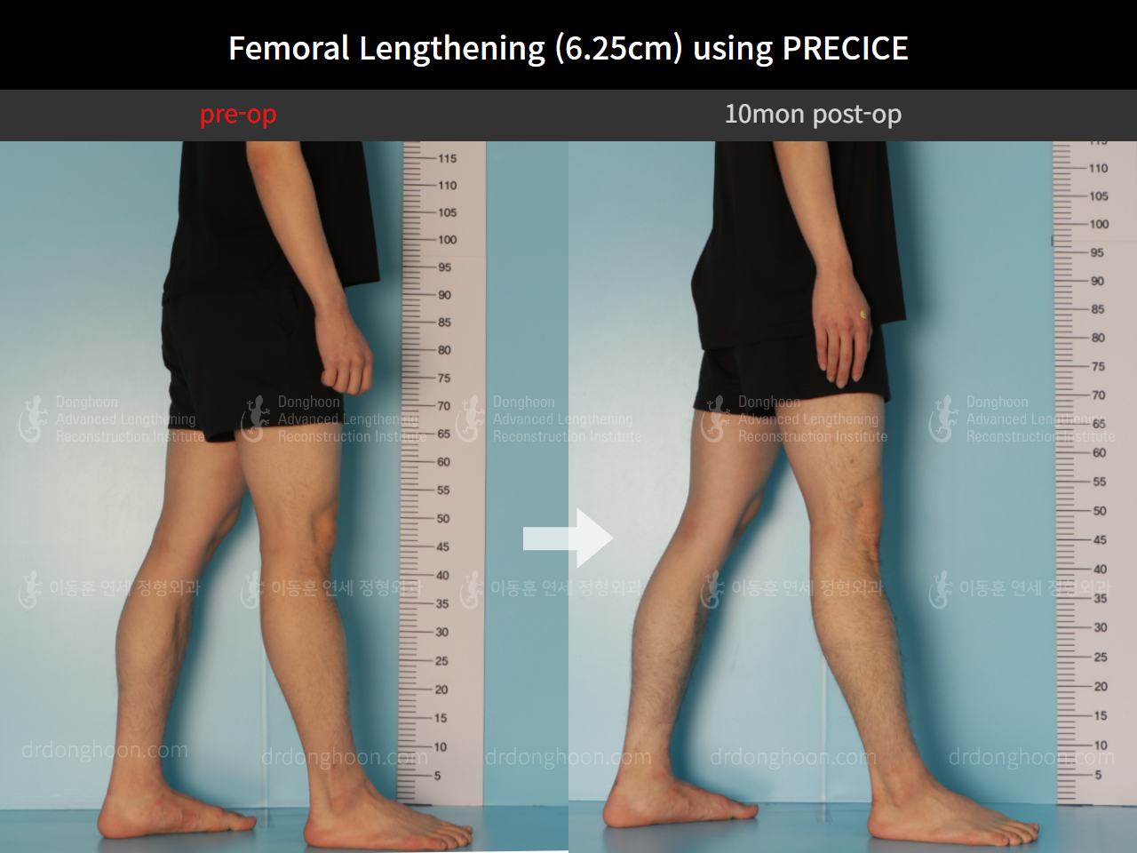 Before and after cll precice, case 8759307, image 7, Dr. Donghoon institute (DALRI)