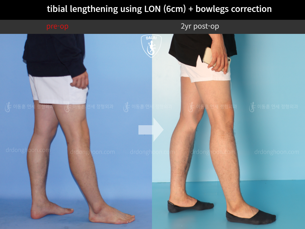 Before and after cll + deformity correction, case 4323155, image 8, Dr. Donghoon institute (DALRI)