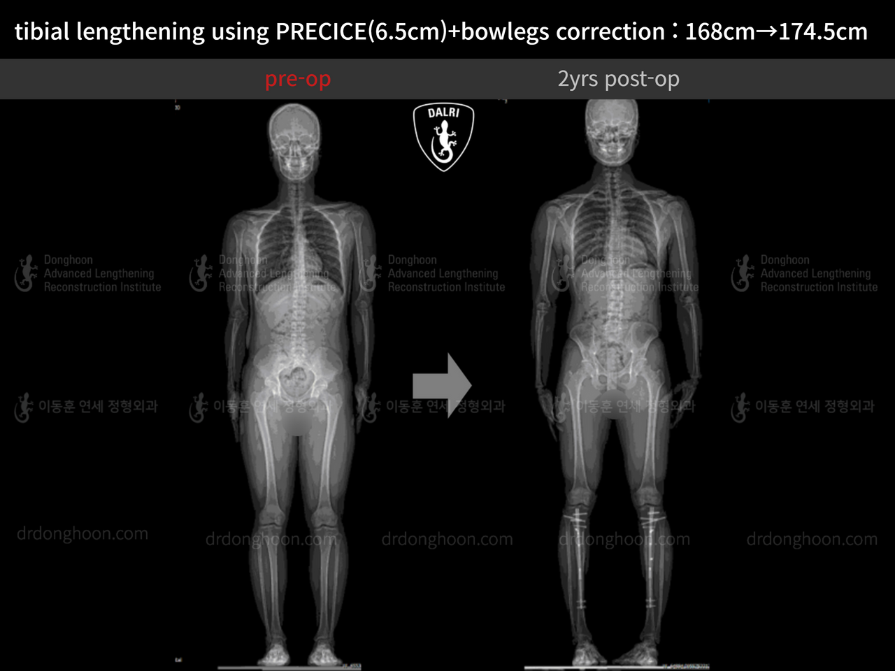 Before and after cll + deformity correction, case 12410003, image 8, Dr. Donghoon institute (DALRI)