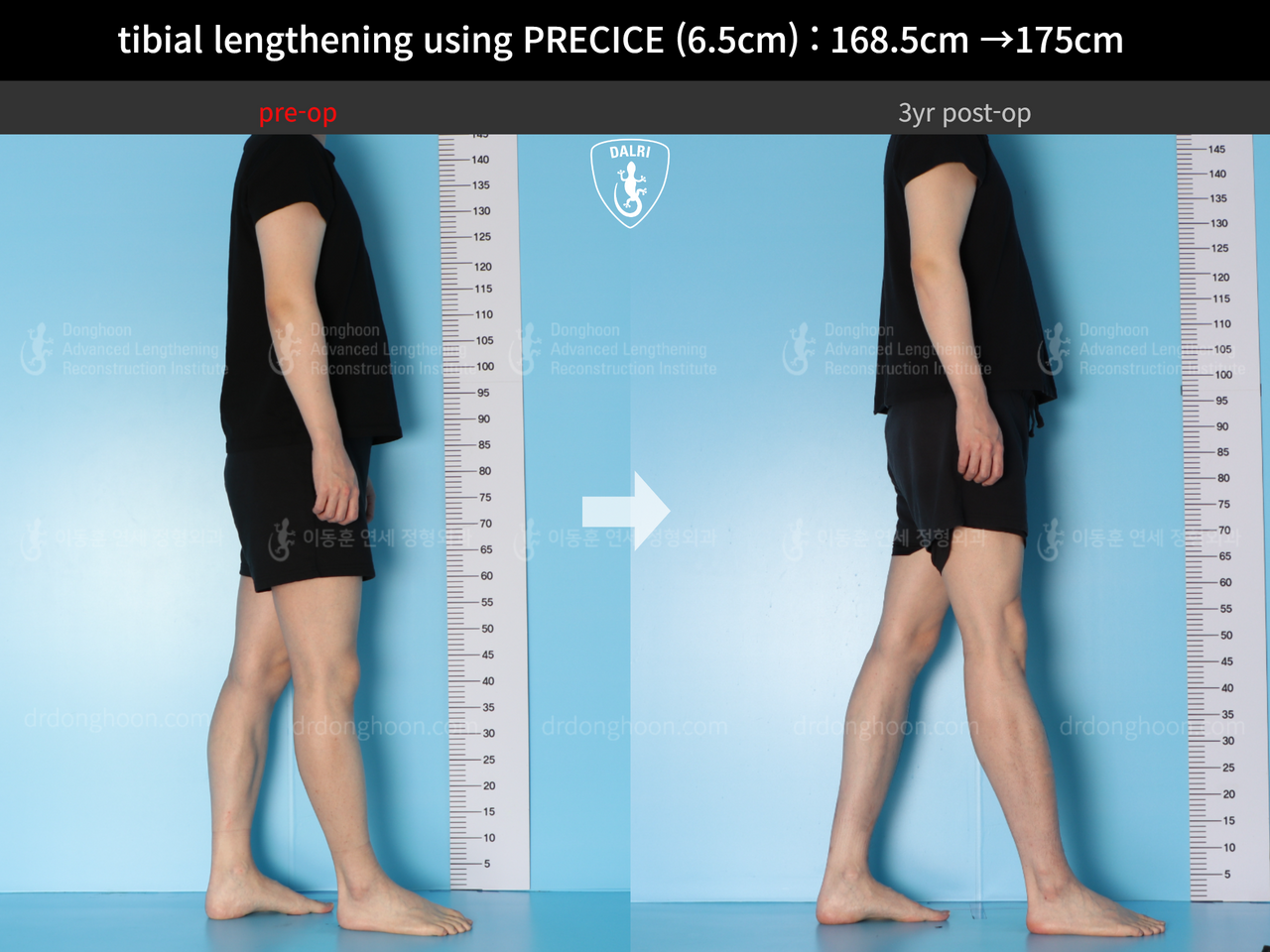 Before and after cll precice, case 13661572, image 5, Dr. Donghoon institute (DALRI)