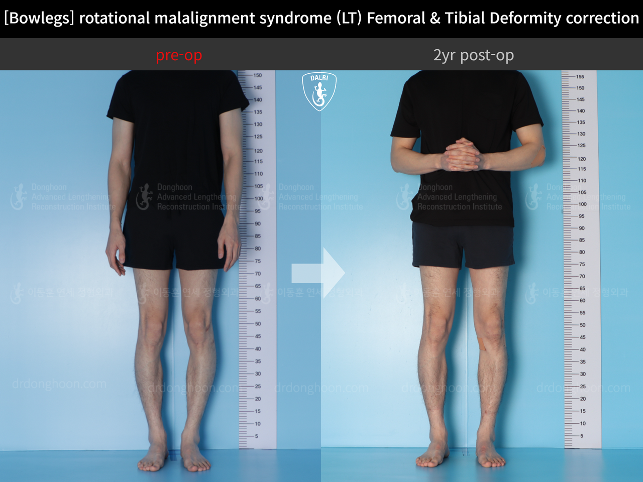 Before and after adult bowlegs, case 13266718, image 3, Dr. Donghoon institute (DALRI)