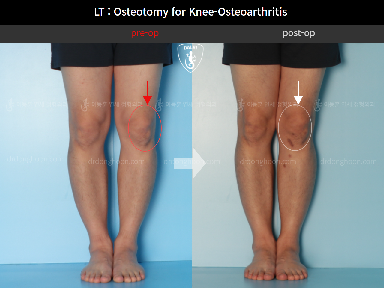 Before and after osteotomy for knee osteoarthritis, case 11065448, image 2, Dr. Donghoon institute (DALRI)