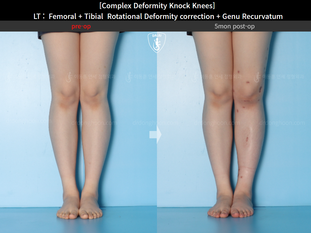 Before and after genu recurvatum, case 16212778, image 8, Dr. Donghoon institute (DALRI)