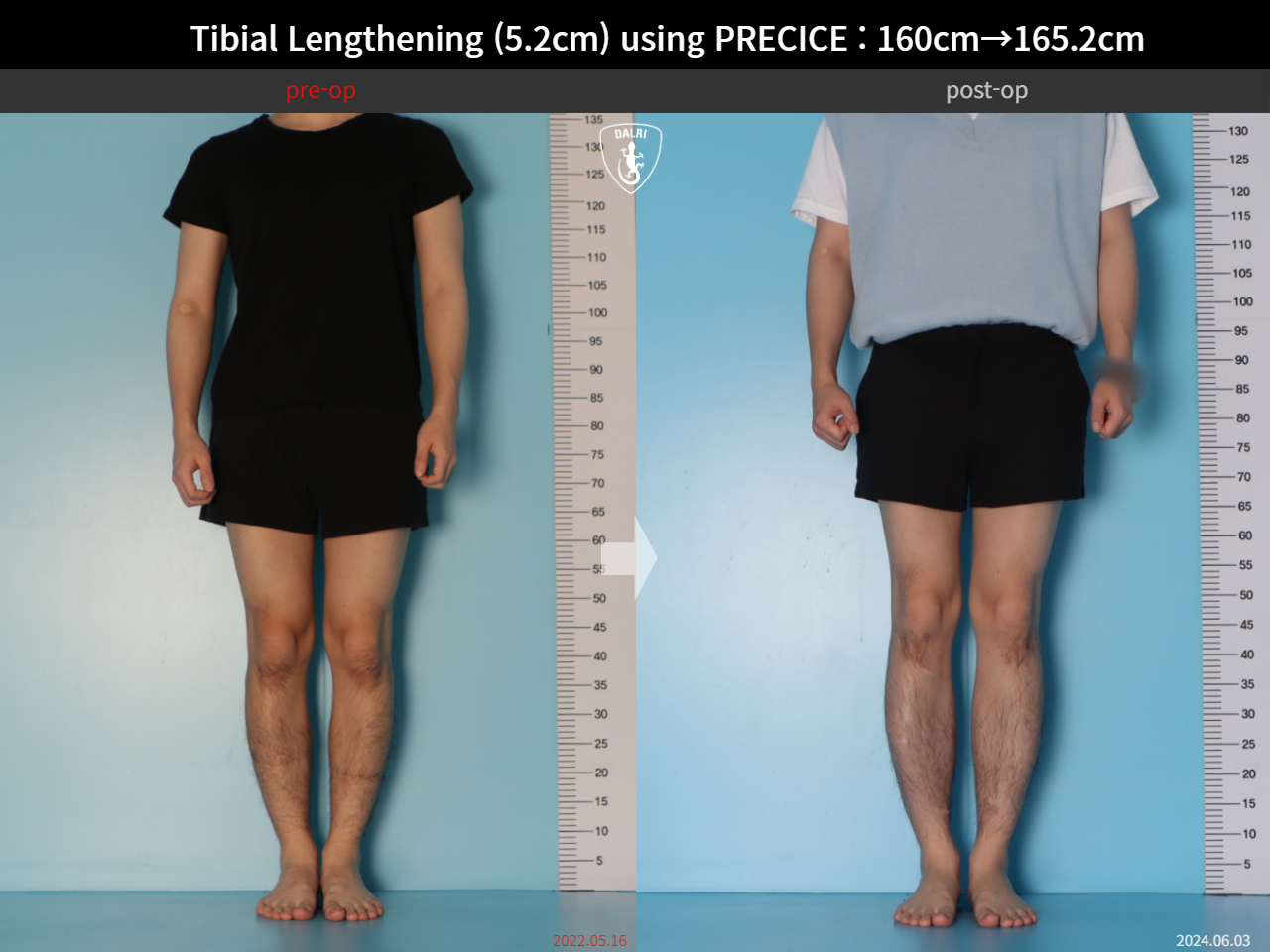 Before and after cll precice, case 27370351, image 1, Dr. Donghoon institute (DALRI)