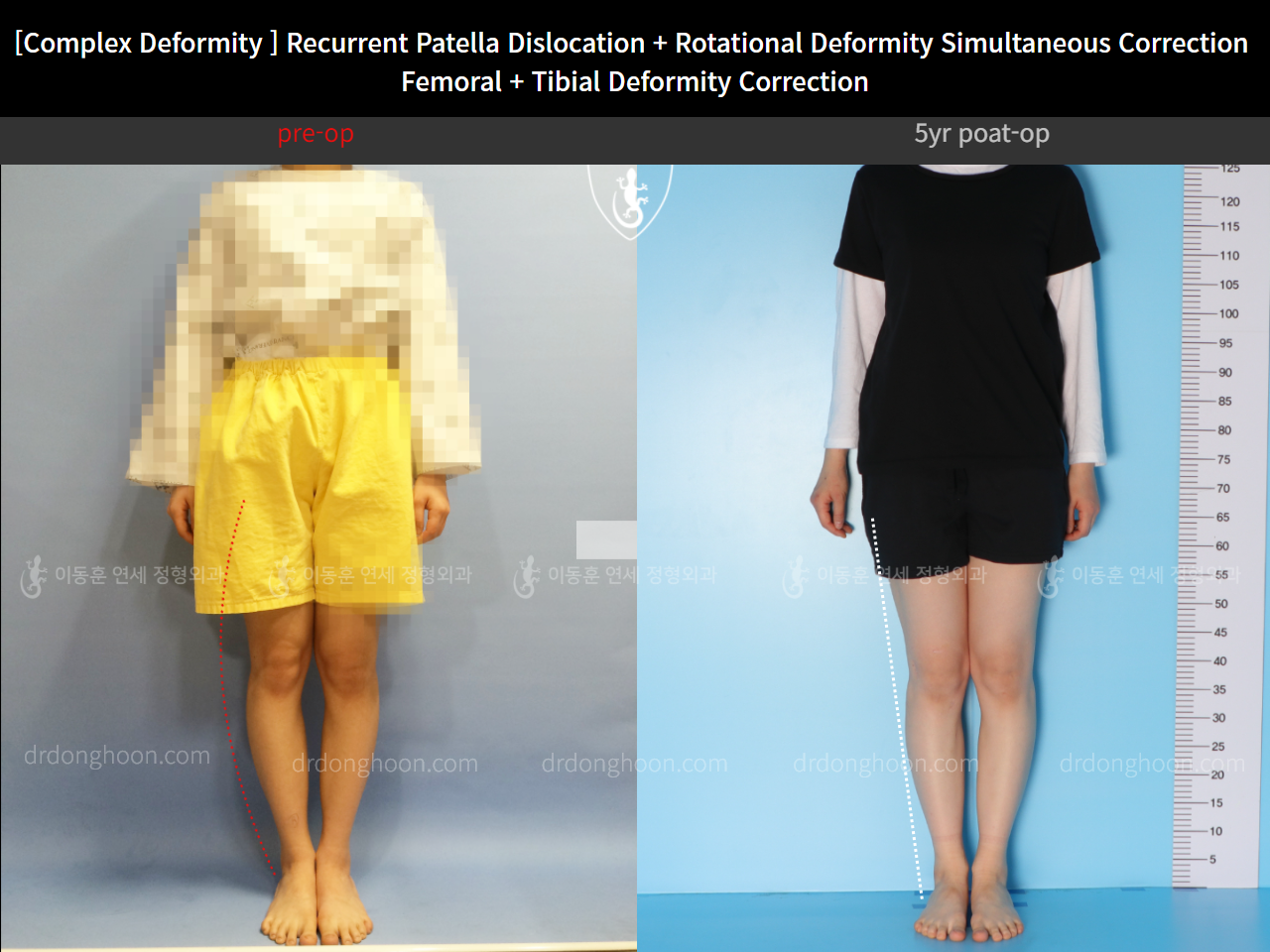 Before and after recurrent patella dislocation, case 10475088, image 3, Dr. Donghoon institute (DALRI)
