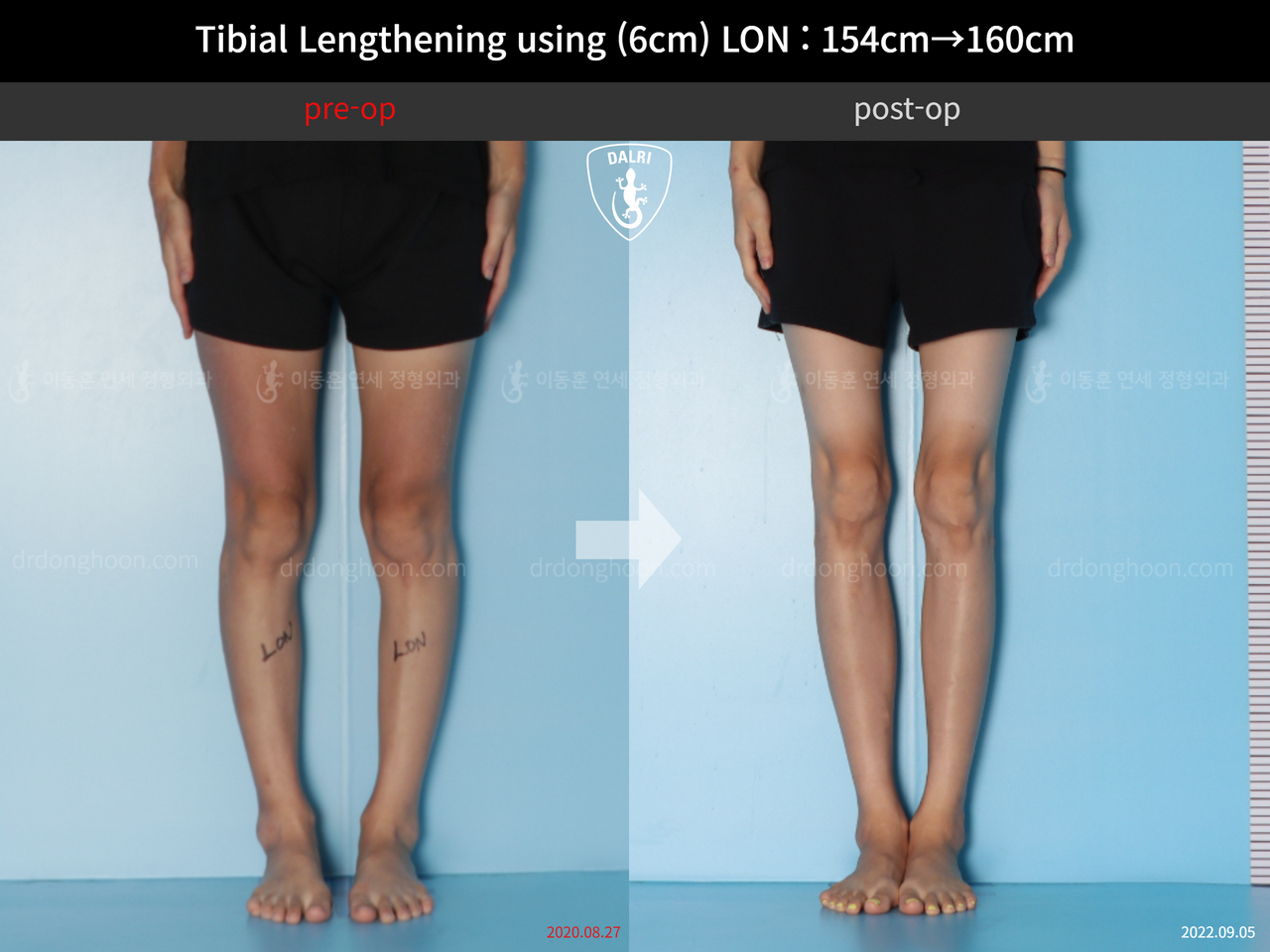 Before and after cll lon, case 12786266, image 5, Dr. Donghoon institute (DALRI)