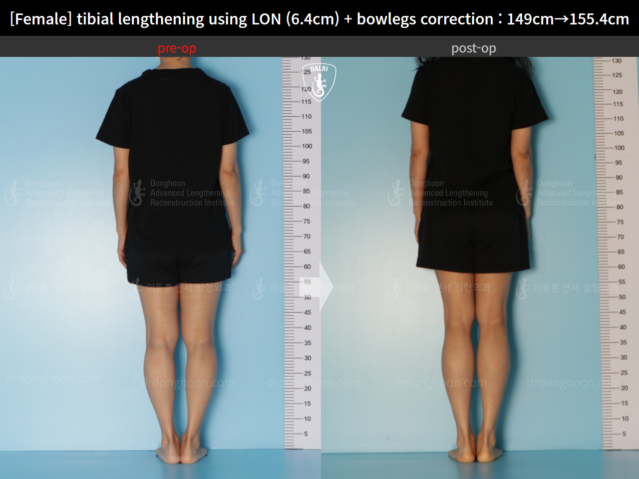 Before and after cll + deformity correction, case 15615036, image 2, Dr. Donghoon institute (DALRI)
