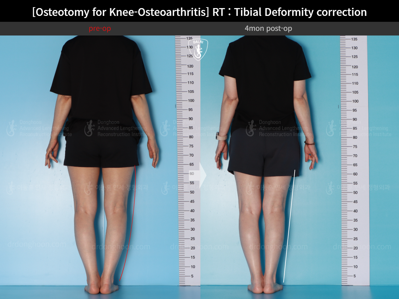 Before and after osteotomy for knee osteoarthritis, case 17890677, image 4, Dr. Donghoon institute (DALRI)