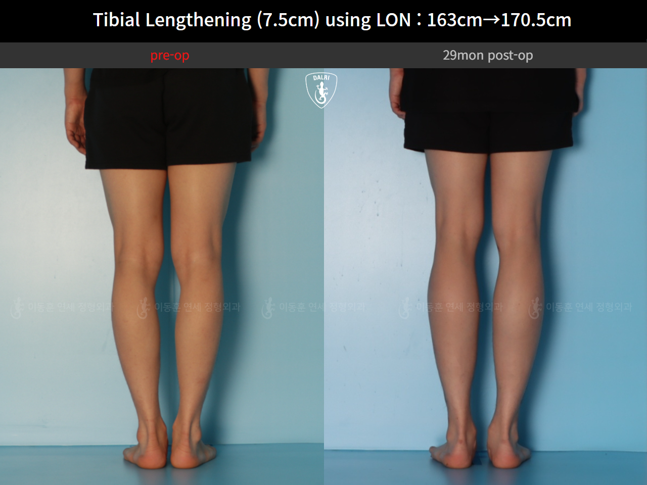 Before and after cll lon, case 127341676, image 8, Dr. Donghoon institute (DALRI)