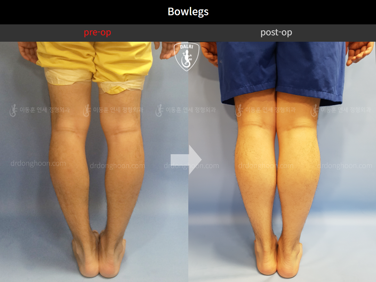 Before and after adult bowlegs, case 10629004, image 2, Dr. Donghoon institute (DALRI)