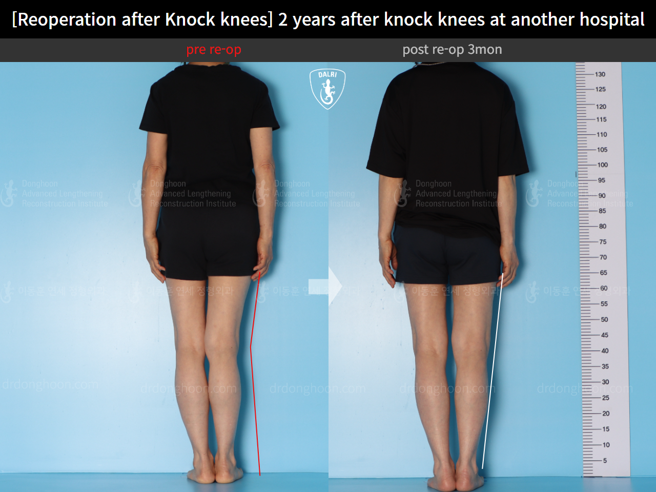 Before and after reoperation after deformity correction, case 15622876, image 4, Dr. Donghoon institute (DALRI)