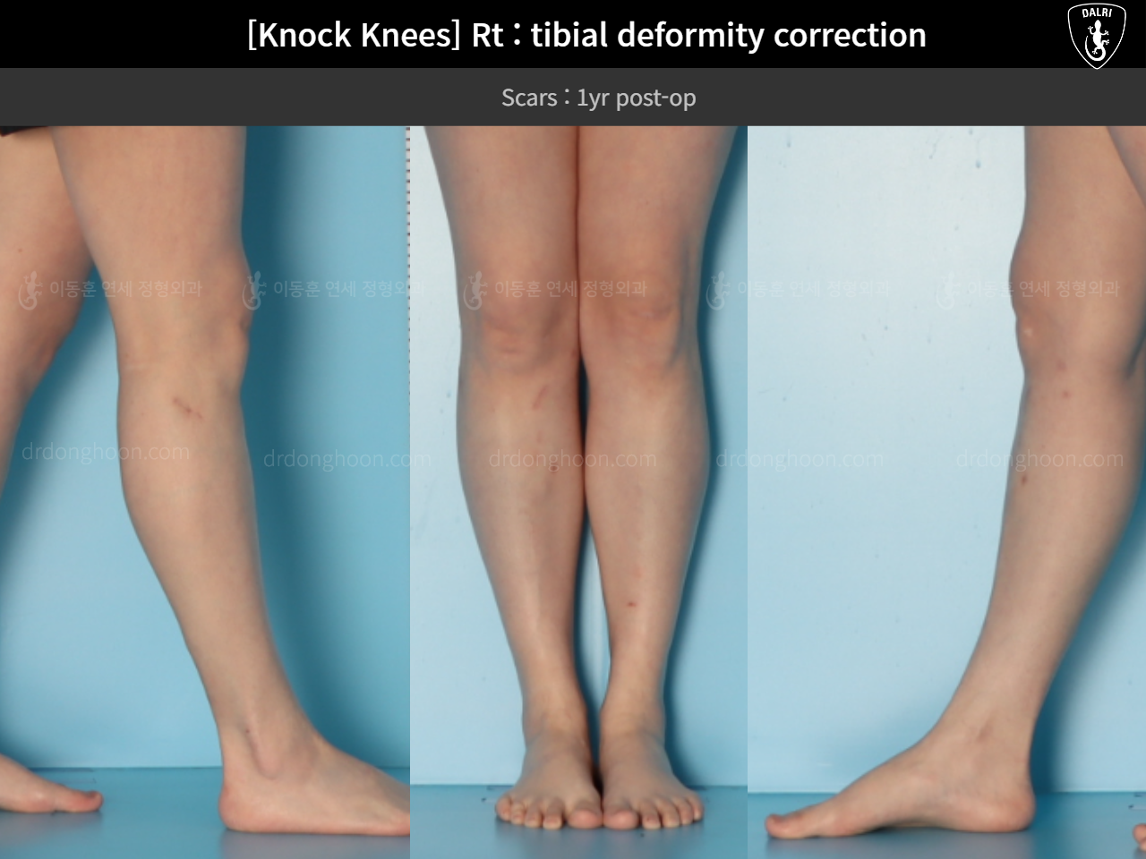 Before and after adult knock knees, case 18411627, image 9, Dr. Donghoon institute (DALRI)