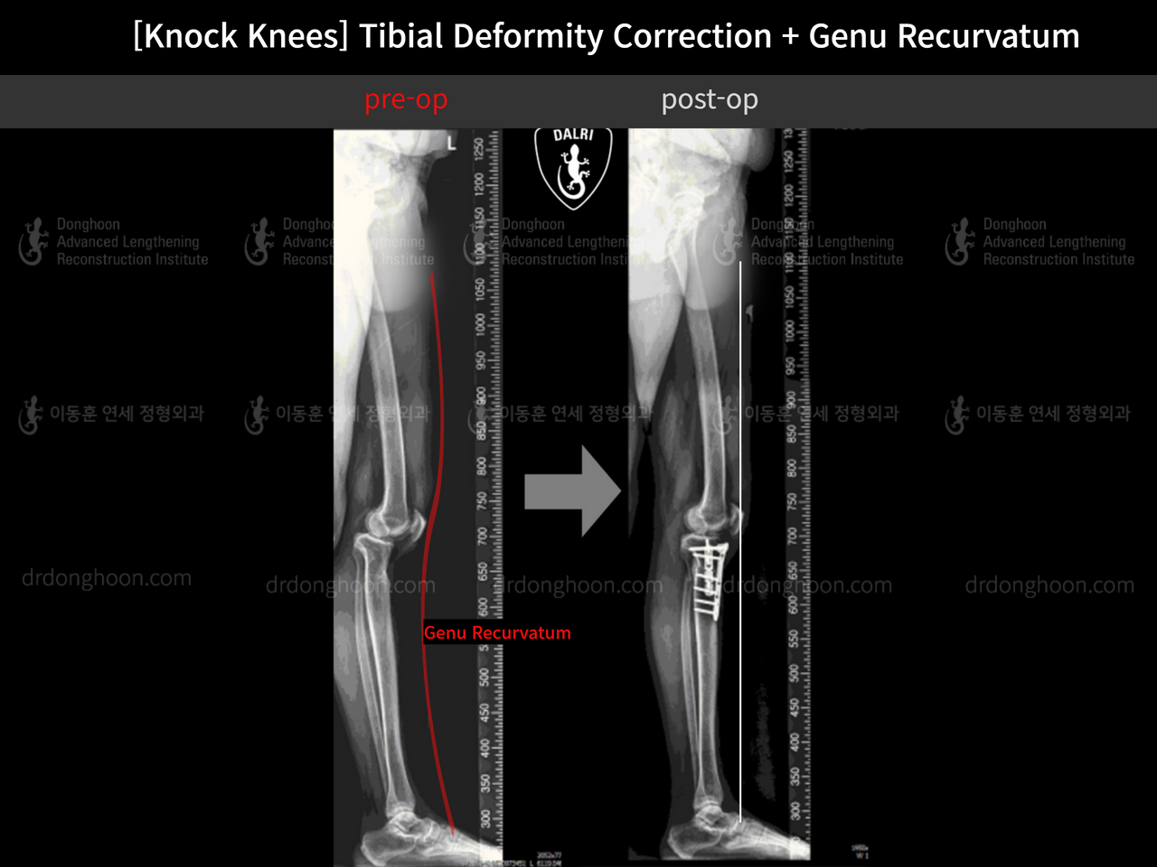 Before and after adult knock knees, case 12846255, image 8, Dr. Donghoon institute (DALRI)