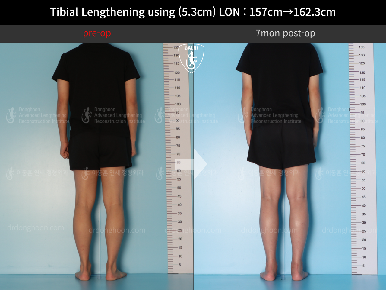 Before and after cll lon, case 12844512, image 4, Dr. Donghoon institute (DALRI)