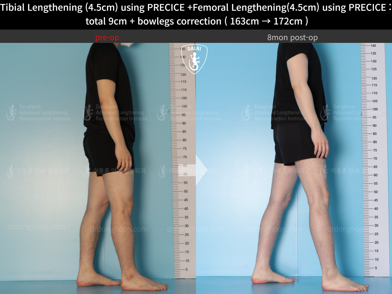 Before and after cll precice, case 13912585, image 7, Dr. Donghoon institute (DALRI)