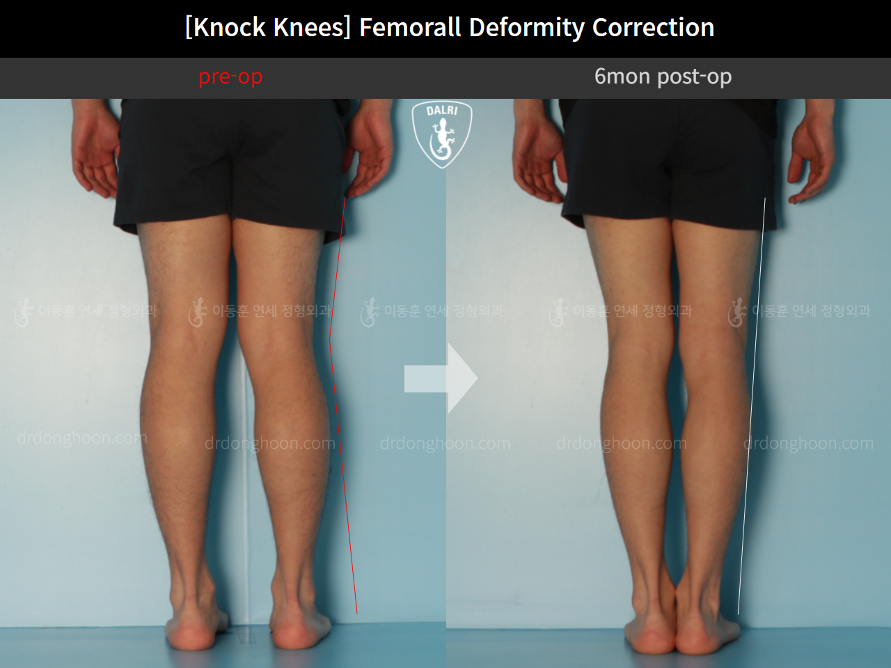 Before and after adult knock knees, case 11773301, image 4, Dr. Donghoon institute (DALRI)