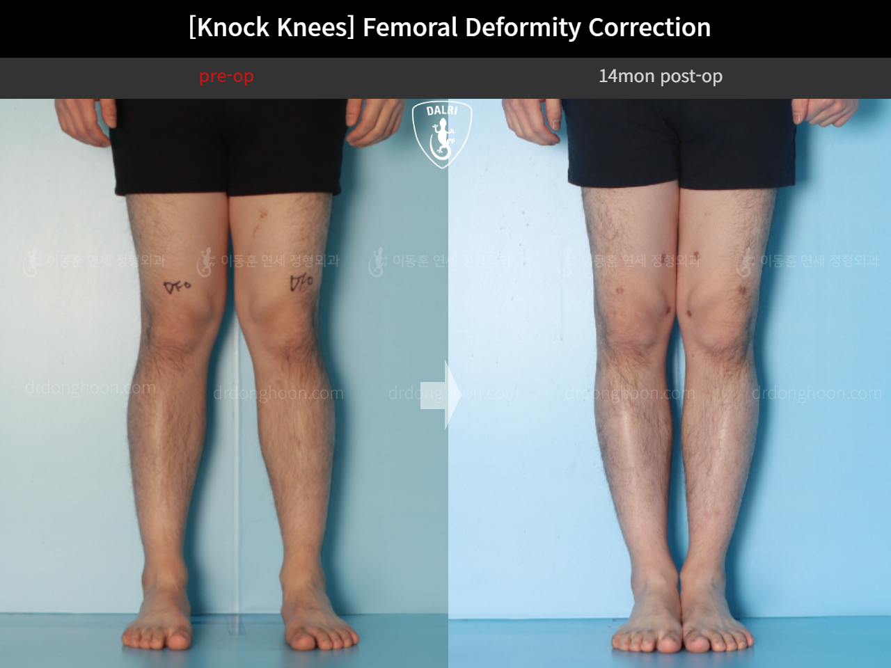Before and after adult knock knees, case 15816319, image 7, Dr. Donghoon institute (DALRI)
