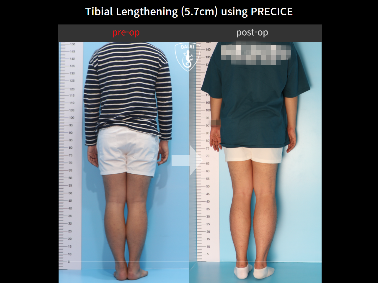 Before and after cll precice, case 4323384, image 2, Dr. Donghoon institute (DALRI)