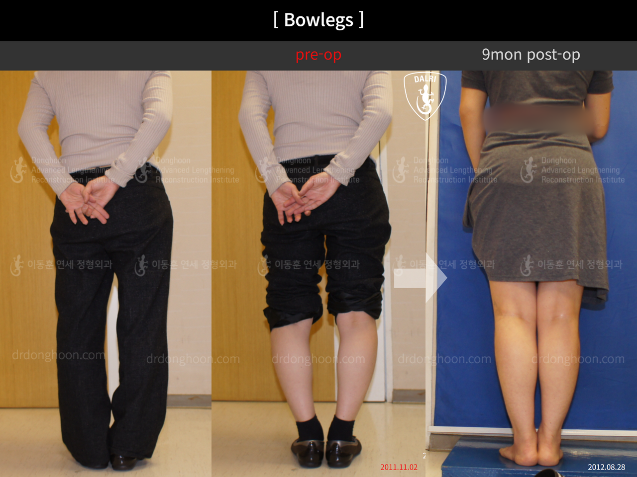 Before and after adult bowlegs, case 12756570, image 2, Dr. Donghoon institute (DALRI)