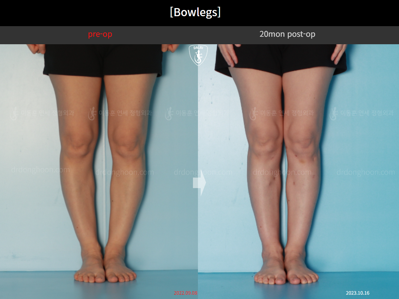 Before and after adult bowlegs, case 16724630, image 5, Dr. Donghoon institute (DALRI)