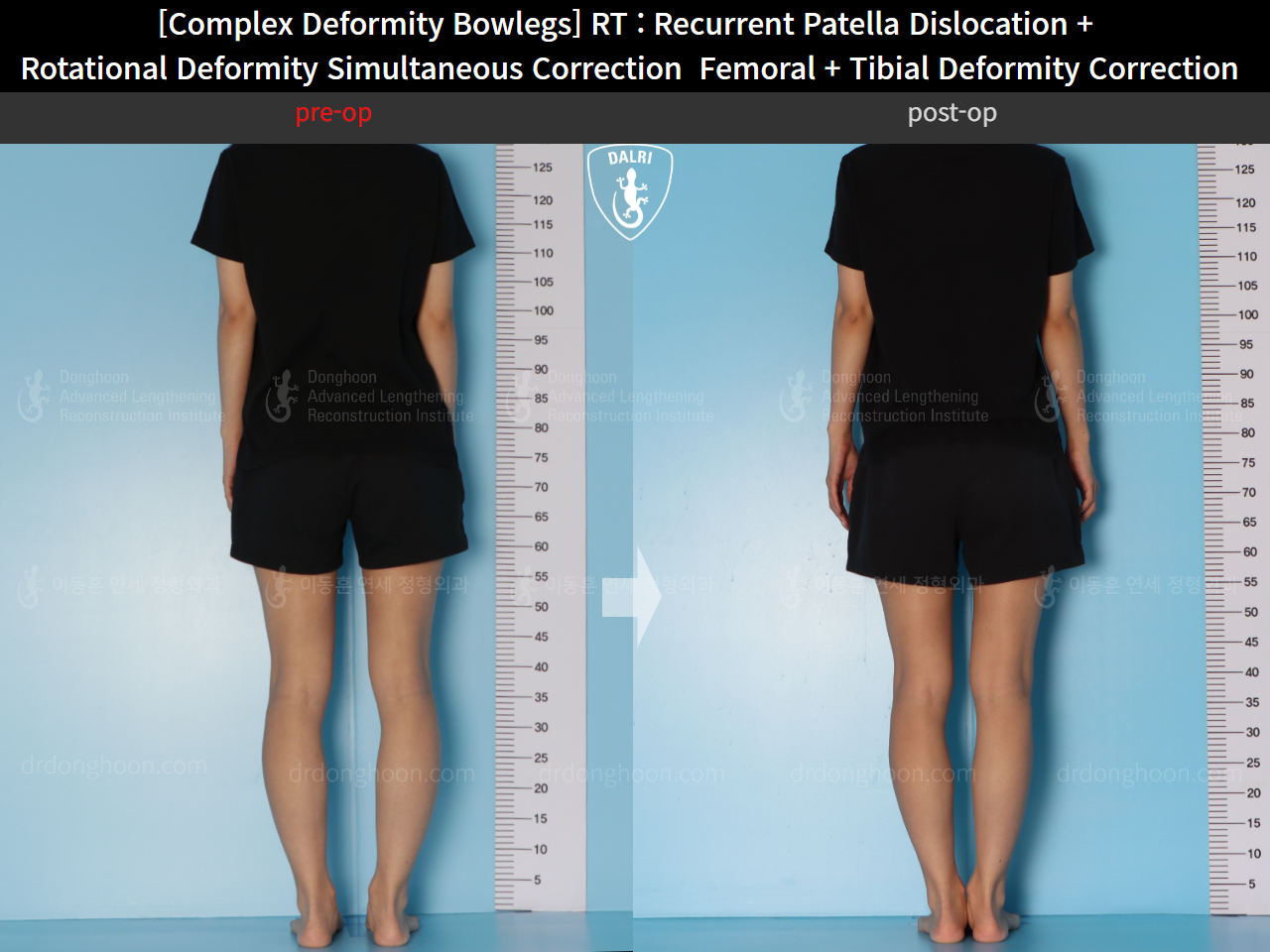 Before and after adult bowlegs, case 14960899, image 4, Dr. Donghoon institute (DALRI)