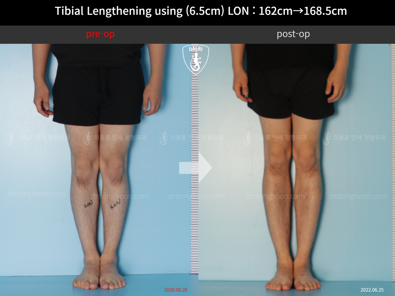 Before and after cll lon, case 11944171, image 5, Dr. Donghoon institute (DALRI)