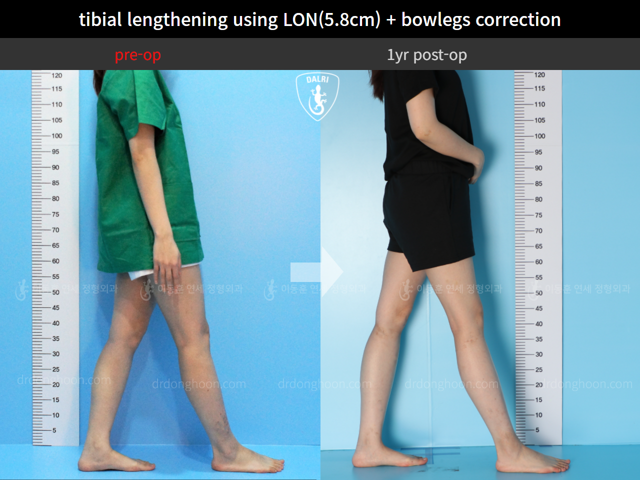 Before and after cll lon, case 4577846, image 3, Dr. Donghoon institute (DALRI)
