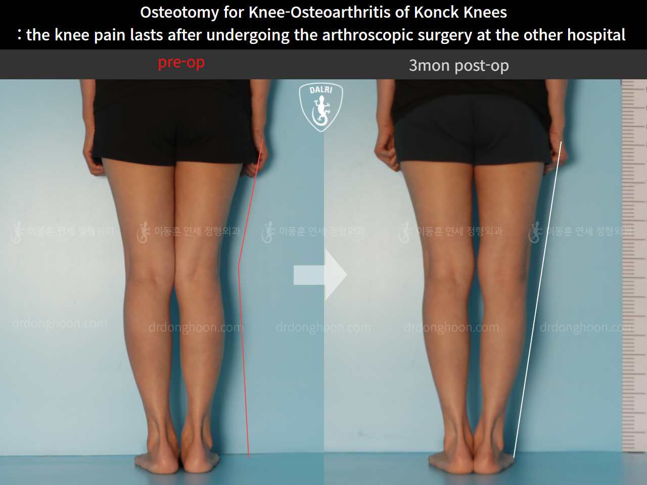 Before and after reoperation after deformity correction, case 10664605, image 4, Dr. Donghoon institute (DALRI)